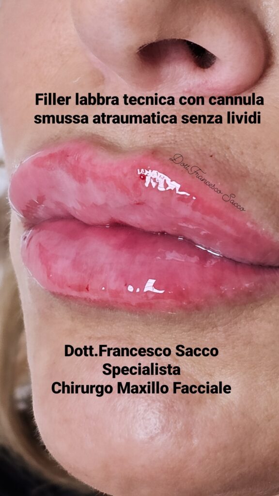 Filler Salerno Dott. Francesco Sacco